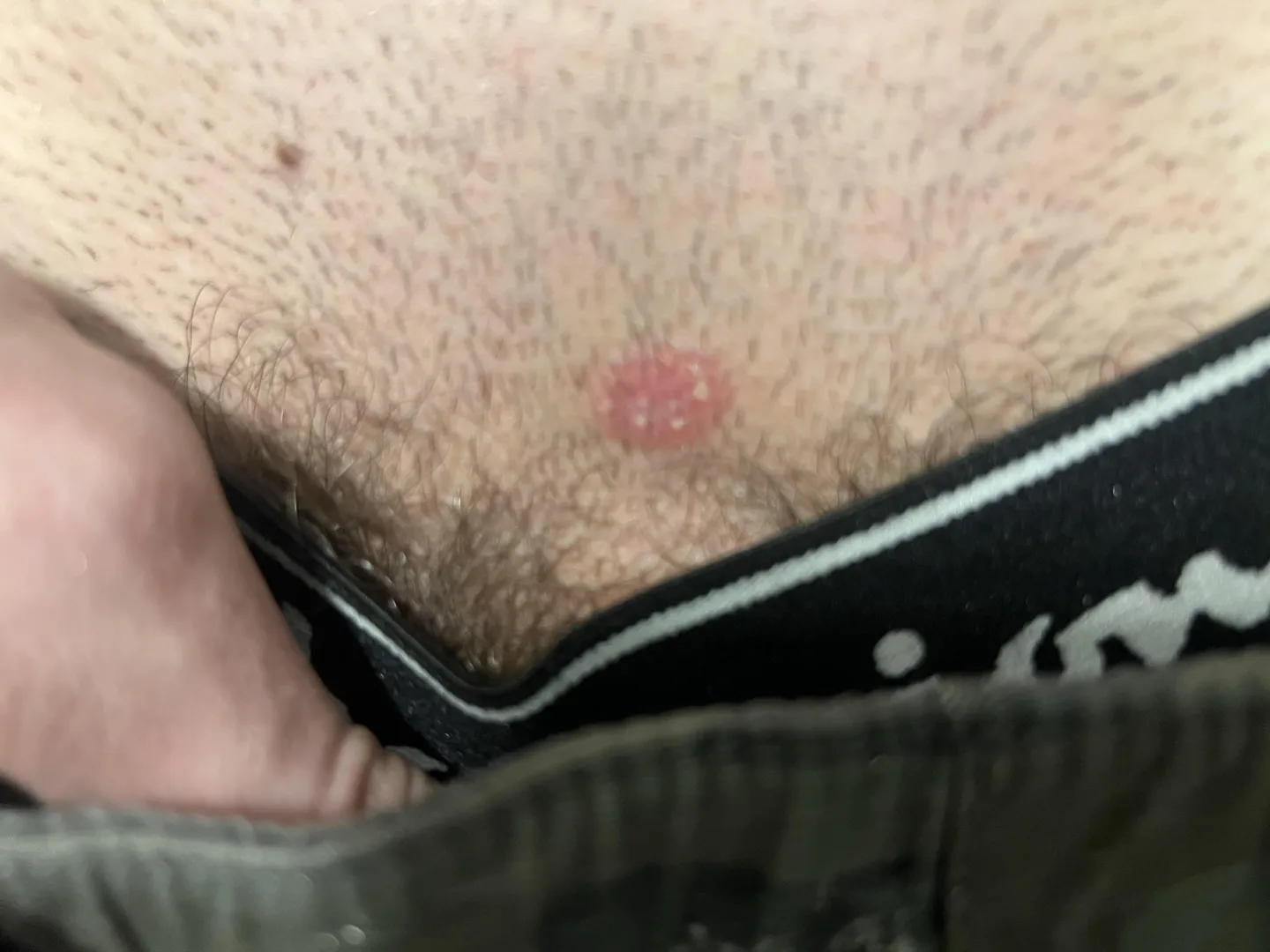 18M, Not sexually active. Red patch near groin area for about a month now. posted by NotAnAltAcc200