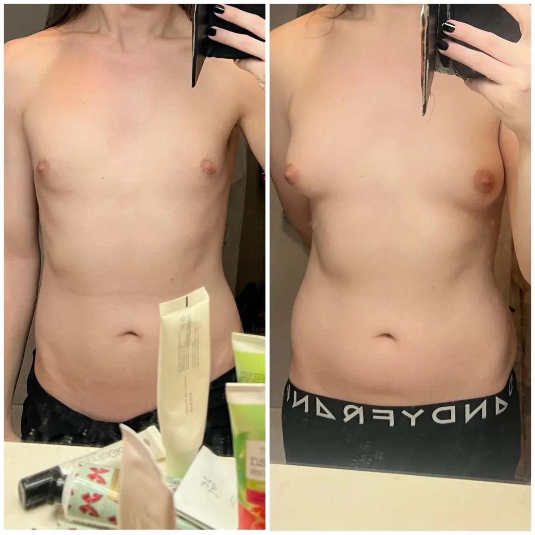 26, 12 months hrt, estrogel+spiro. posted by Lilyyy481516