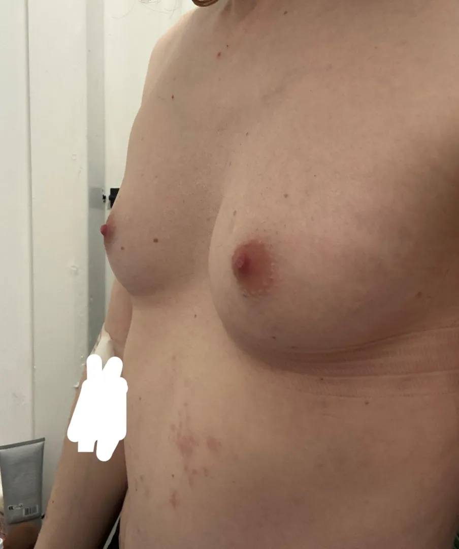 4 years, 6mg EEN IM monotherapy posted by phyllisfromtheoffice