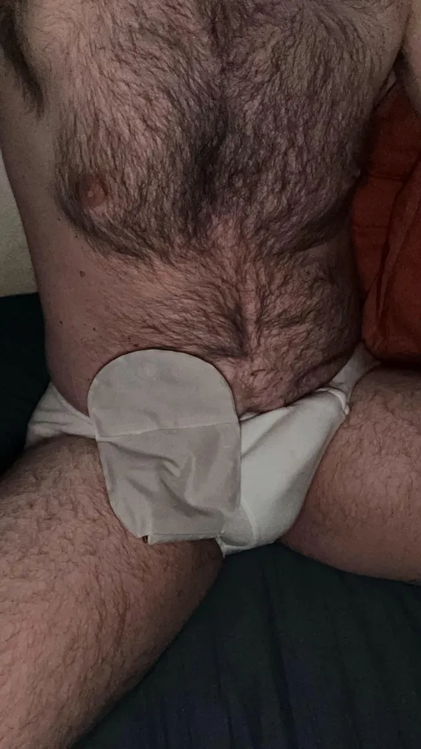 40m ostomy posted by dlse34
