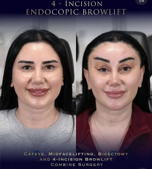 4-Incision Brow Lift! by miserable_millennial