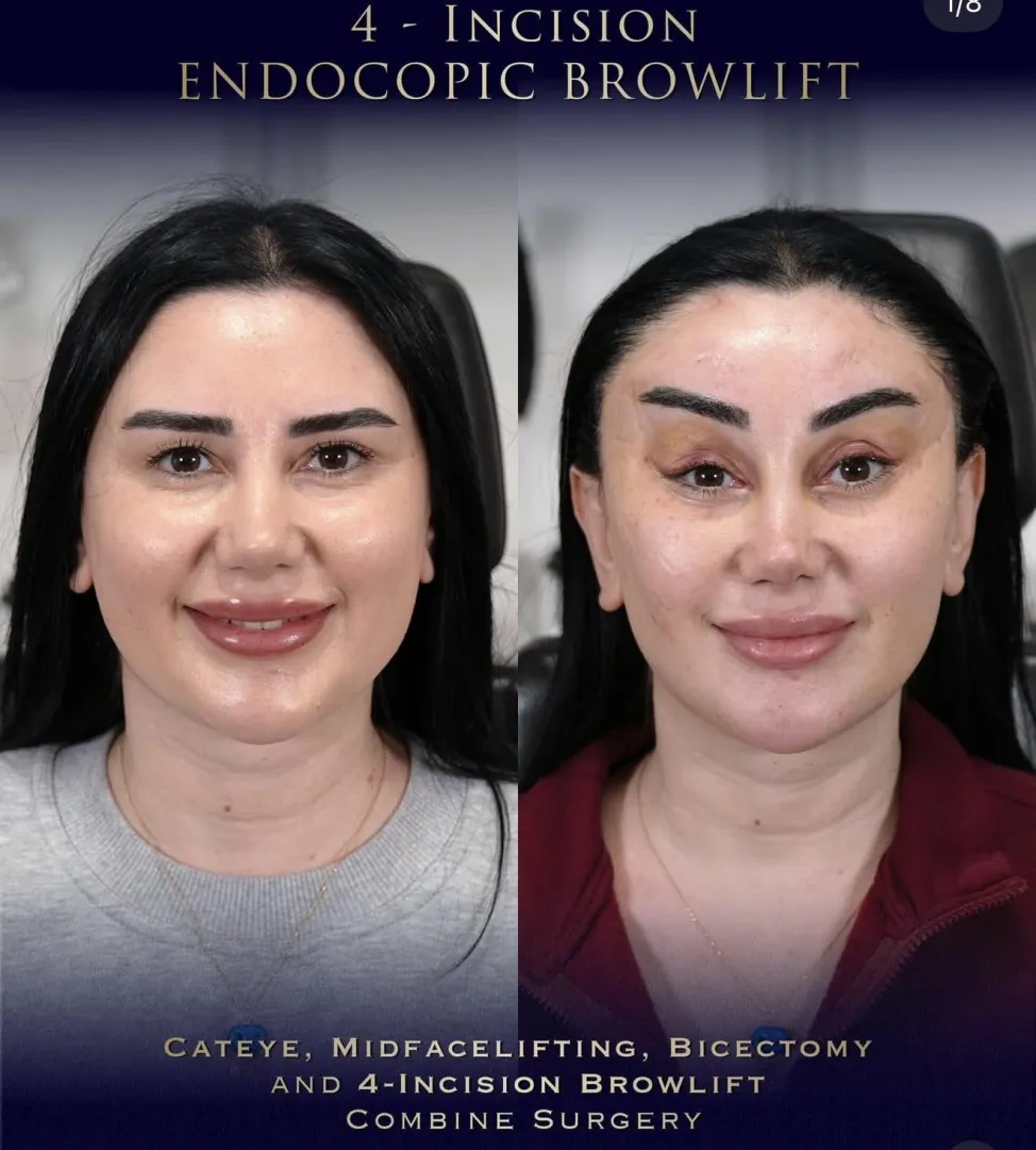 4-Incision Brow Lift! posted by miserable_millennial