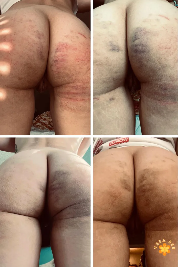 A few days of healing posted by Vera_bee666