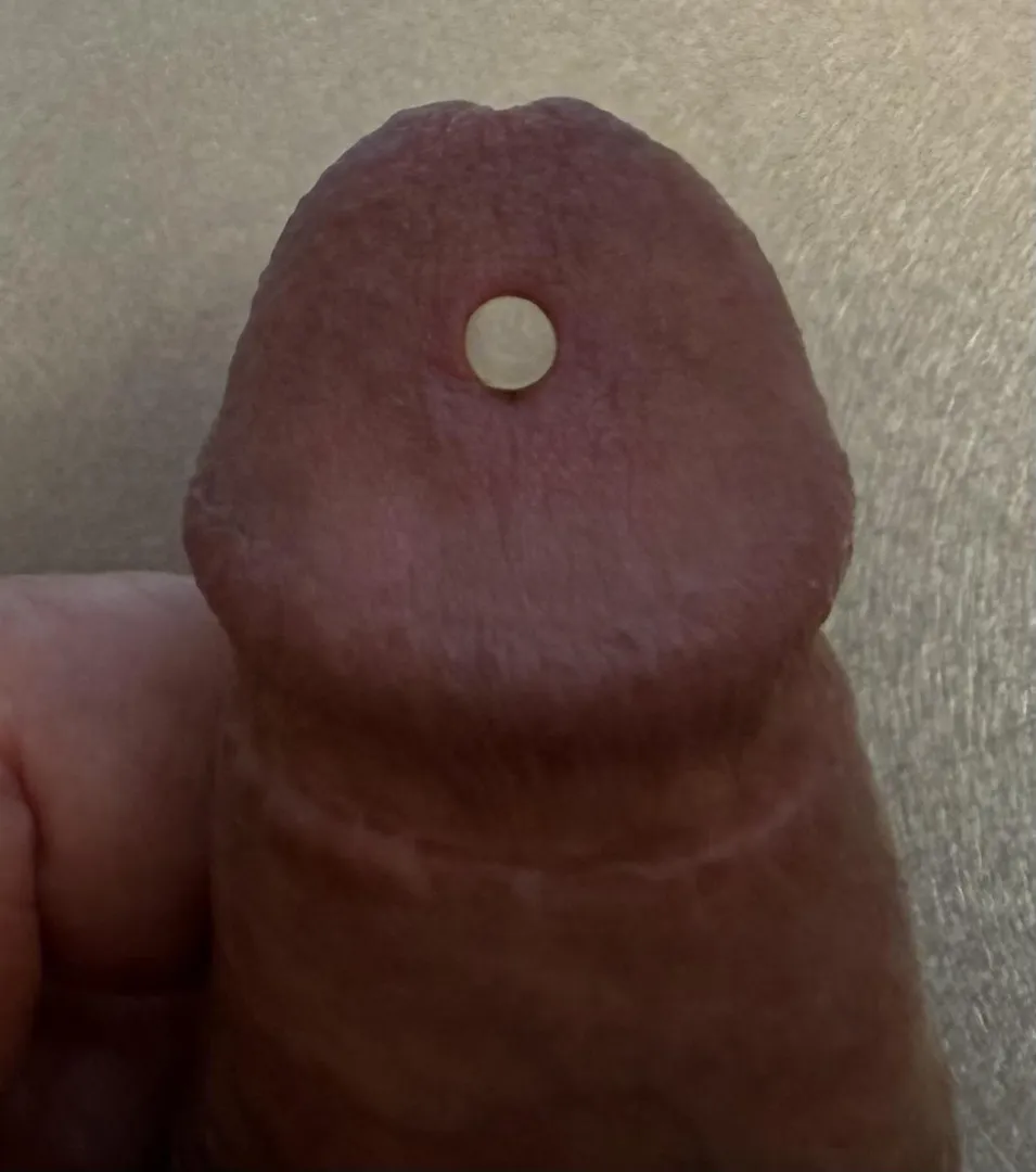 A hole in my glans! posted by HatOutside6972