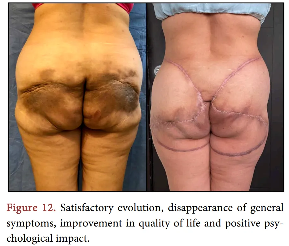 A woman got mineral oil injected in her buttocks for augmentation purposes. 30 years later she needed her butt reconstructed. posted by CatPooedInMyShoe