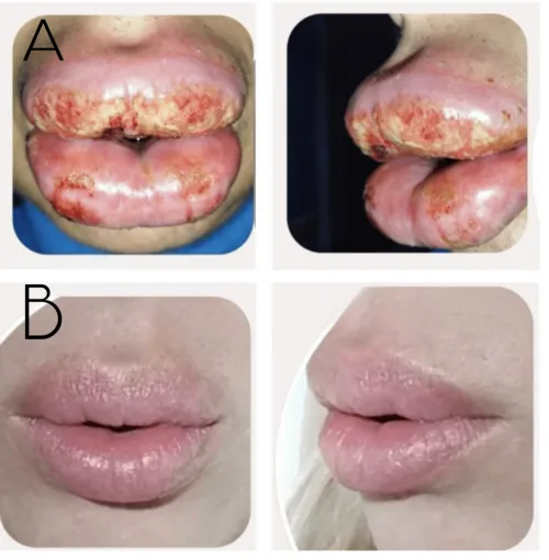 Angioedema and bacterial and viral Infection following hyaluronic acid fillers injection to the lips by CatPooedInMyShoe