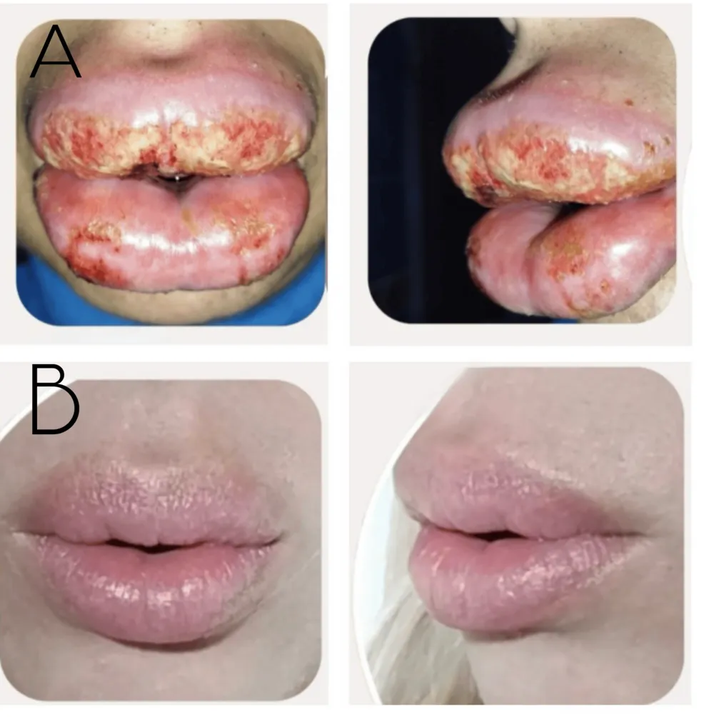 Angioedema and bacterial and viral Infection following hyaluronic acid fillers injection to the lips posted by CatPooedInMyShoe