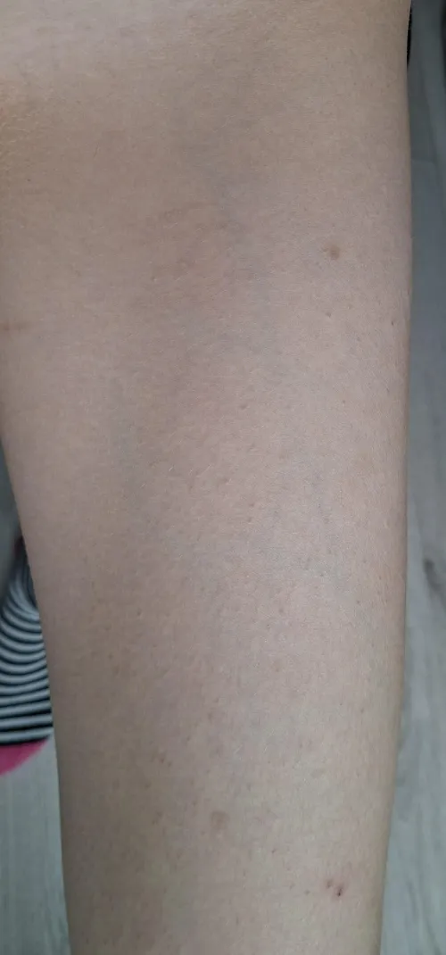 are more visable veins and legs feeling numb reason to be concerned? by cvltpawz