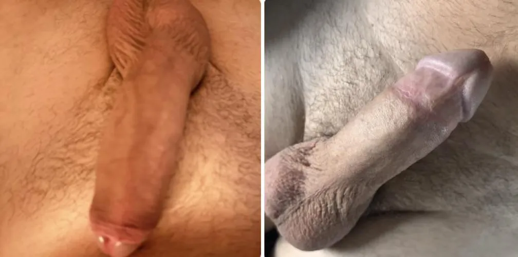 Before and after my adult circumcision by Express-Stars