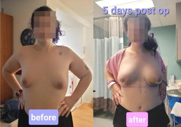 Before/After Breast Augmentation by Lanky-Sail-7132