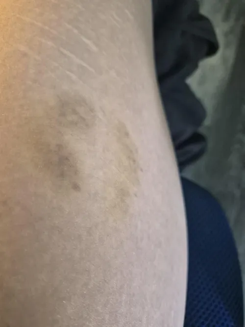 Bite mark bruise on thigh by saraonly420