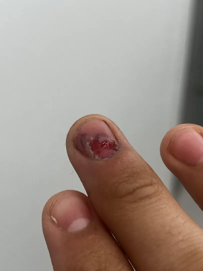 Boxcutter to my nail posted by VirtuallyMexican