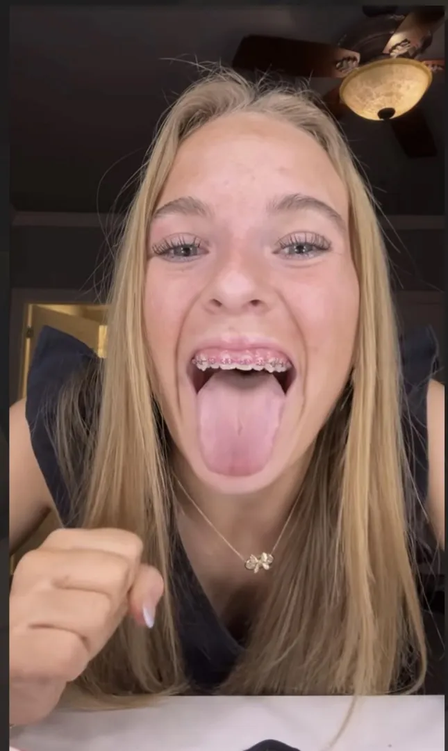 Brace face posted by Medical_Brush968