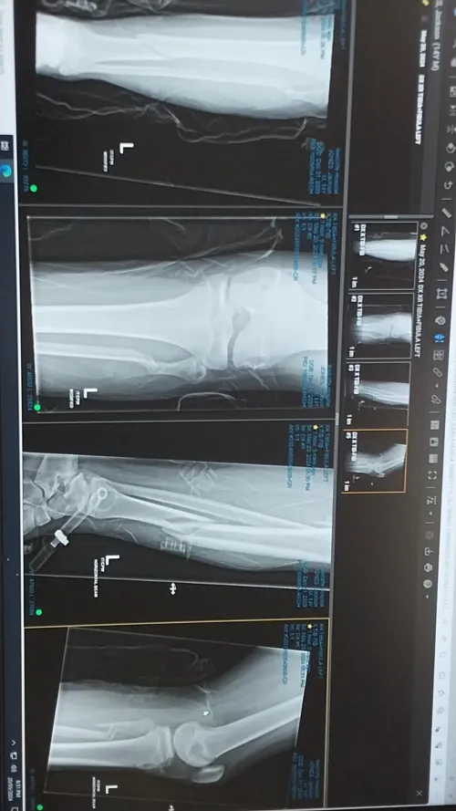 Broke my leg and while ago by off-yo-rockers