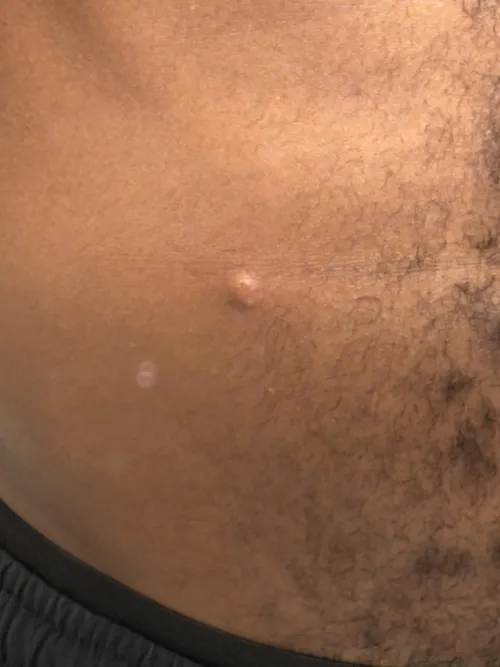 Bump Immediately After Injection by infamous_zen14