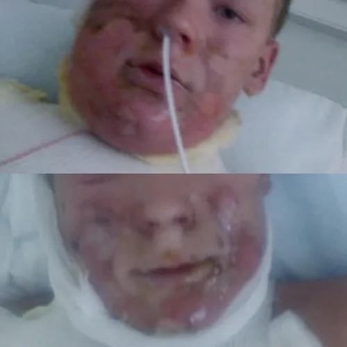 Burned by hakklihajawhatever