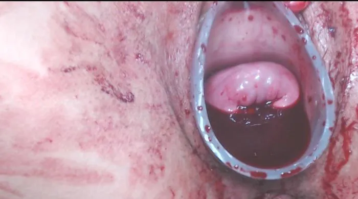 Cervix extreme blood posted by alisson_pun