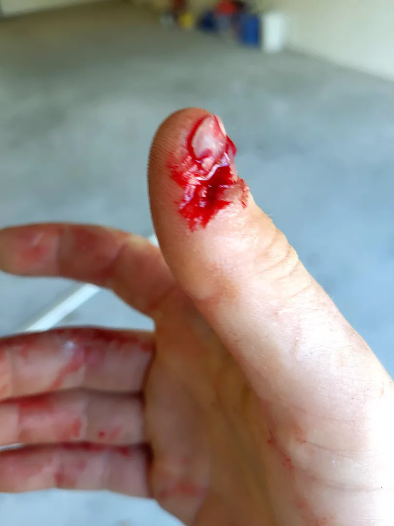 Circular saw kicked back on me and ran over my thumb. posted by Sleazis_McSlutthead