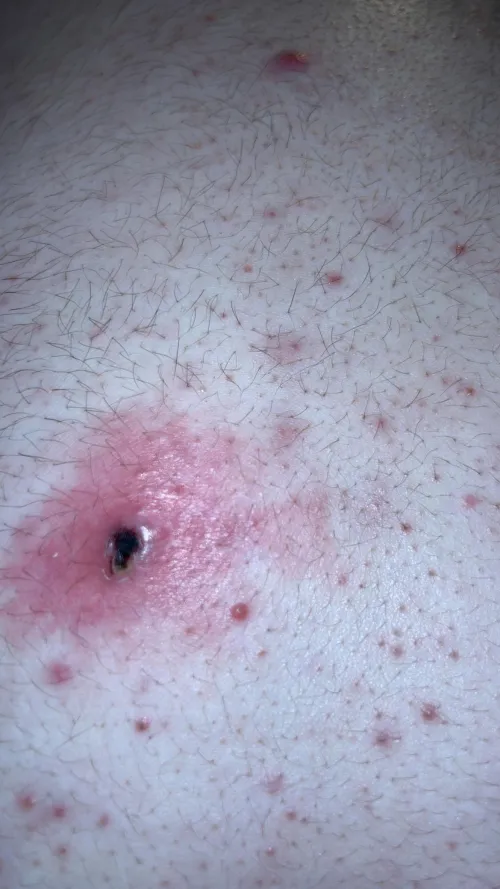 concerned about this on my back i think it's a pimple scabbed over but unsure by Positive_Junket_5985