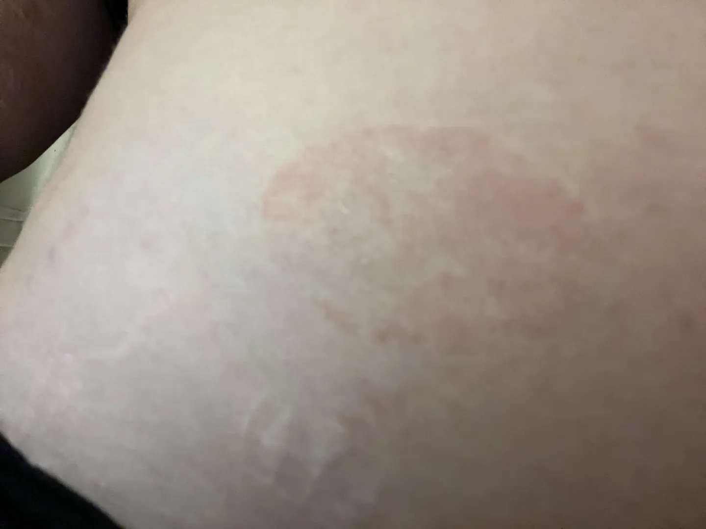 Could this be an allergic reaction, ringworm, or is it something else? posted by Substantial-Error726