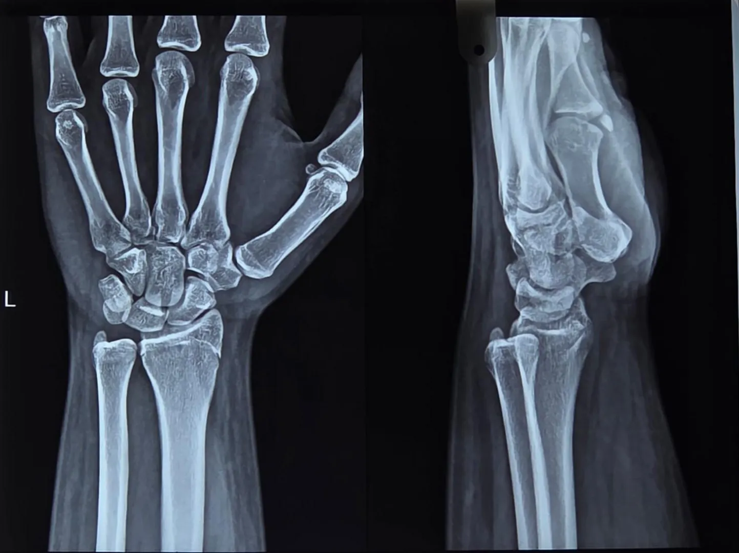 Cracked my wrist, when can I go to the gym and probably start lifting heavy posted by Hopragon