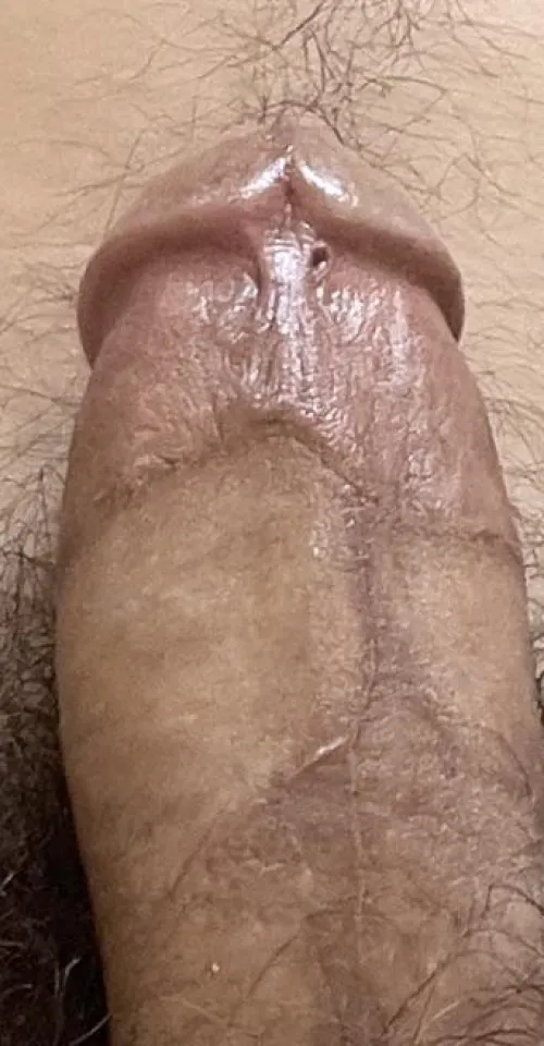 Crooked circumcision scar by handyfuck