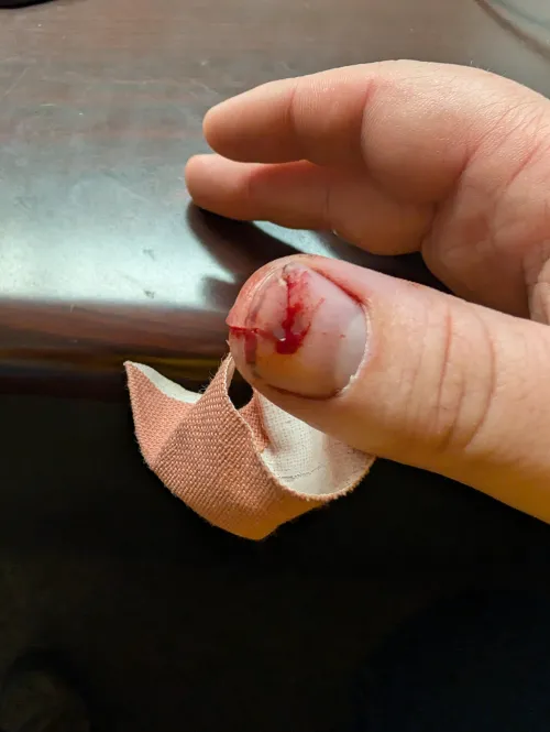 Cut finger from a tree branch by SoILLArbor