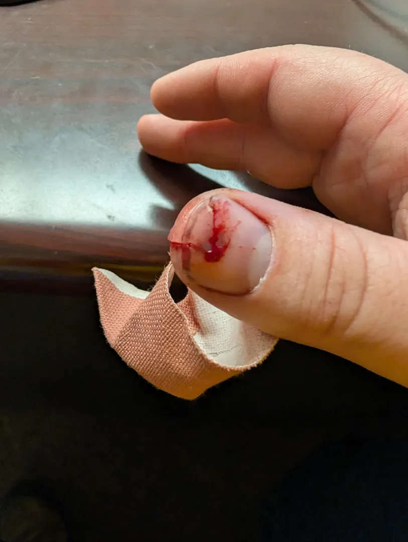 Cut finger from a tree branch posted by SoILLArbor