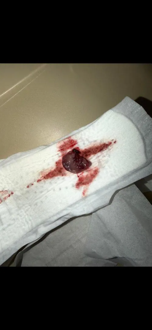 Decidual cast by CassieGgx