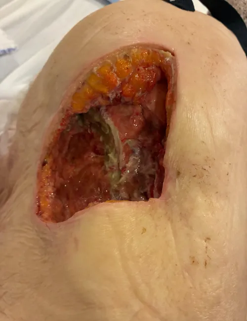 Decubitus ulcer I had the pleasure of doing a wet to dry dressing on the other night. The tunnels were never ending. by Feisty-North6752