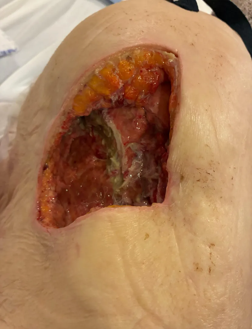 Decubitus ulcer I had the pleasure of doing a wet to dry dressing on the other night. The tunnels were never ending. posted by Feisty-North6752