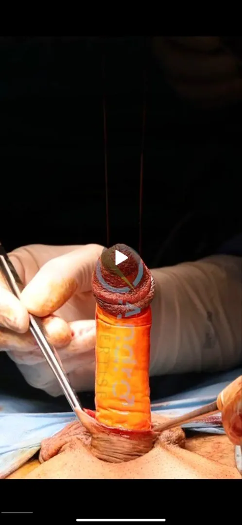 deglovin (full vids my tele Farour33 posted by PassEquivalent2895