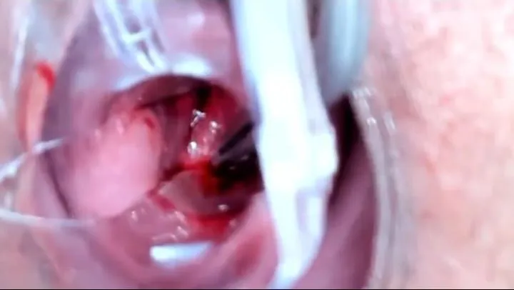 Extreme Cervix Community  posted by alisson_pun