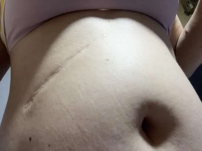 First time showing my scar in public by KitsuneVelvet