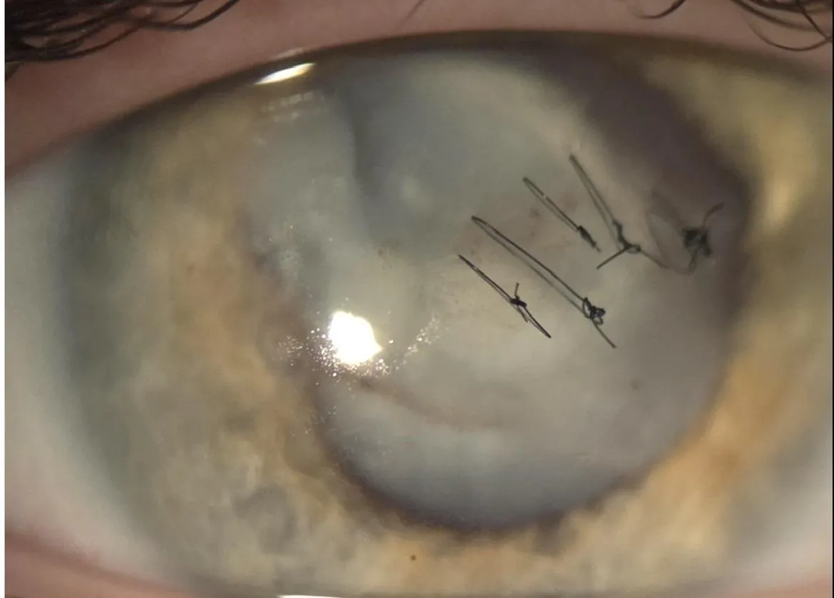 Fish hook in my eye posted by Impressive-Potato110