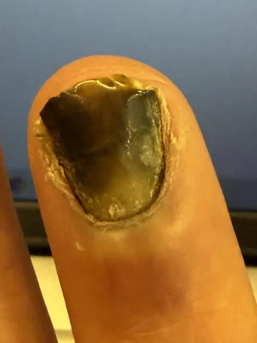 Fungal by thedukeinc