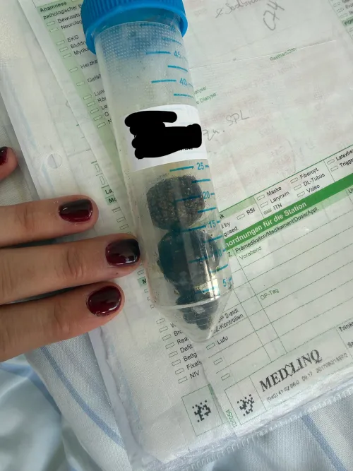 Gallstone by HartKomisch