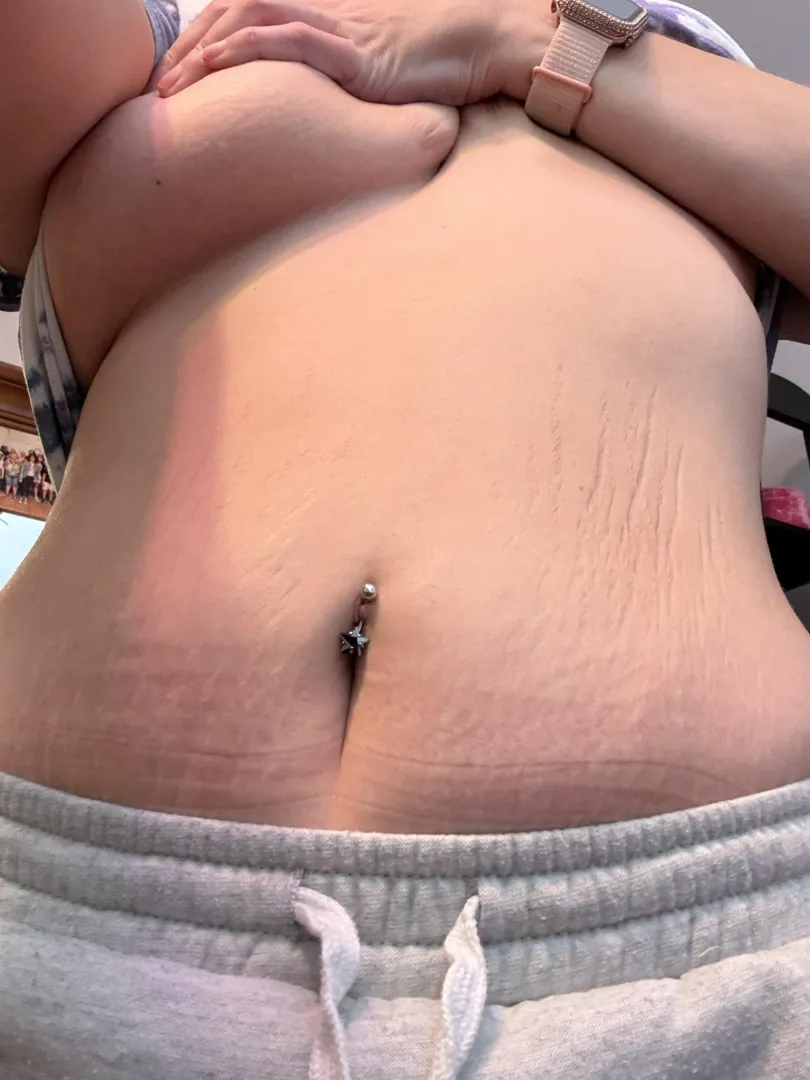 Gastric sleeve success story posted by BabygirlLuneStar