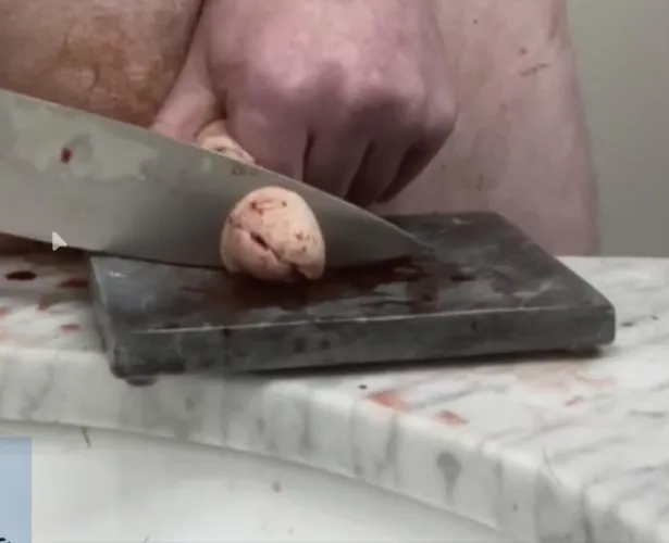 Glansectomy in progress by CRColt