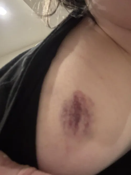 Human bite through a thick sweater. by Andr3w1ndrag