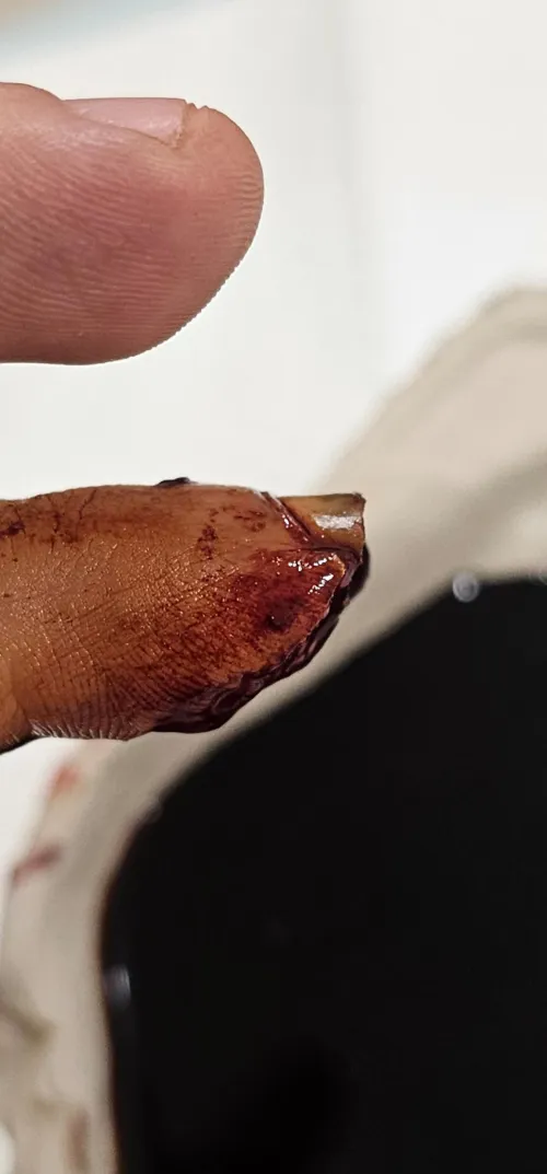 I cut the tip of my finger off at work by Spark_Chaser