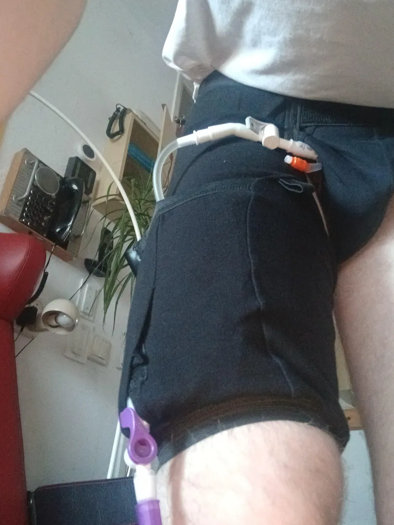 I have found a comfy leg bag day holder no irritation no nothing it hols every bag for the day that is square and have a adapte opening to every drain valve its around you waist supported and around your leg i have this 24/7 now on i have 2 time this thi posted by baak20001