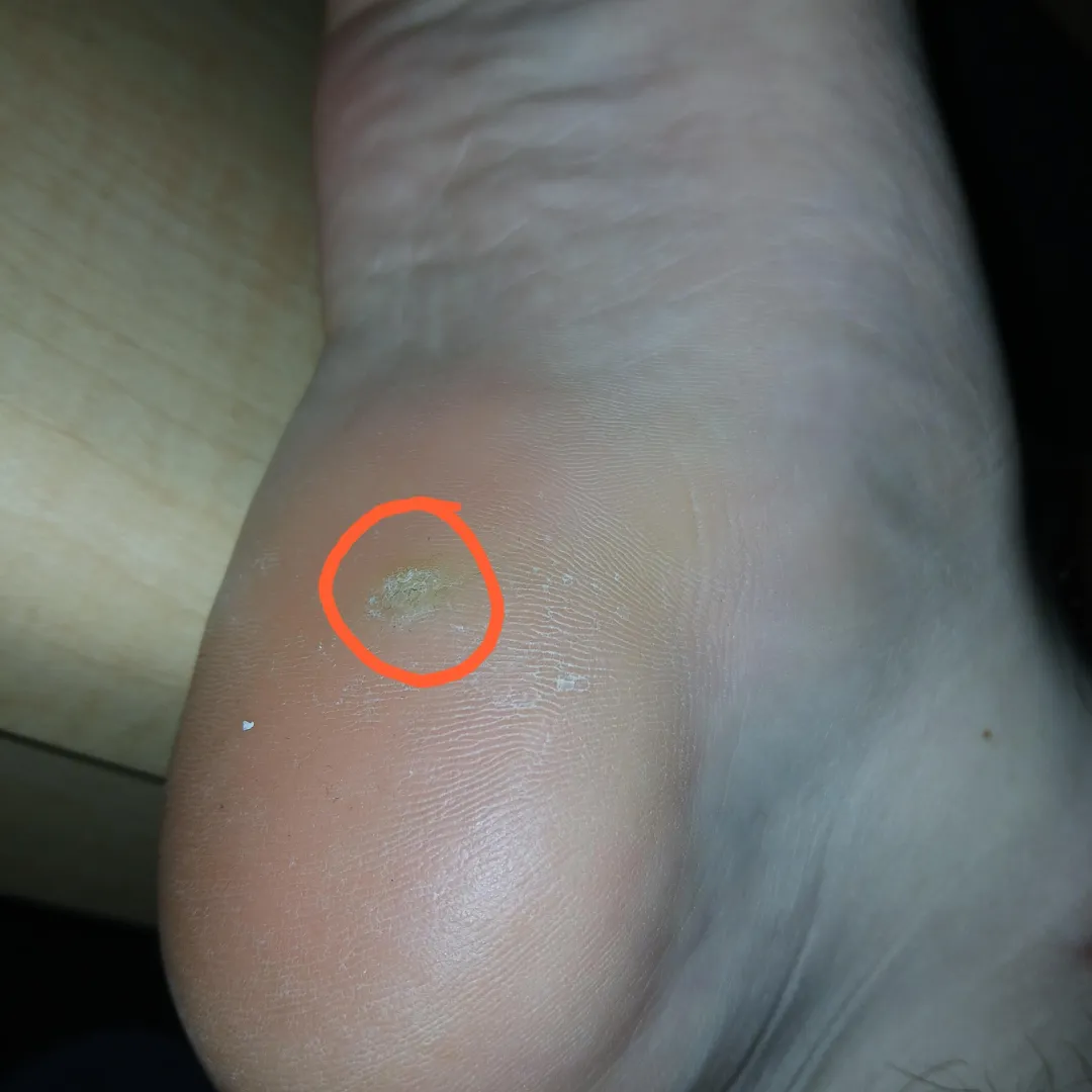I have this hard, circular thing on the bottom of my right foot. I don't know if it's a callus, a corn, or something else. What is it and what should I do? posted by ProtectionPuzzled362