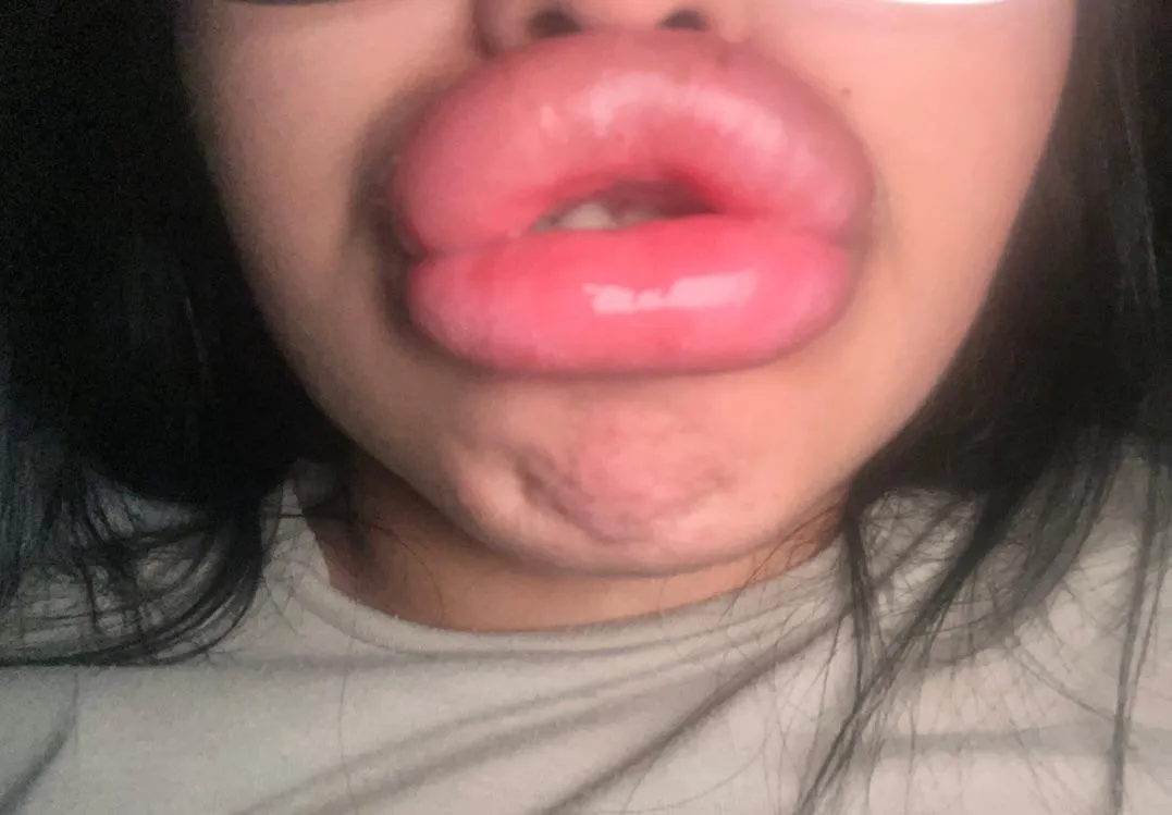 I urgently need fillers posted by _sgzg1