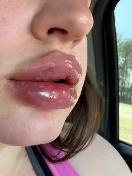 I went in to a lip filler appointment yesterday to get 2 more ML. When I got there she had another injector come in and tell me they wouldn’t do my lips, told me “I don’t even want to show you your side profile of your lips”, and said I should pu by TheSophieSteele