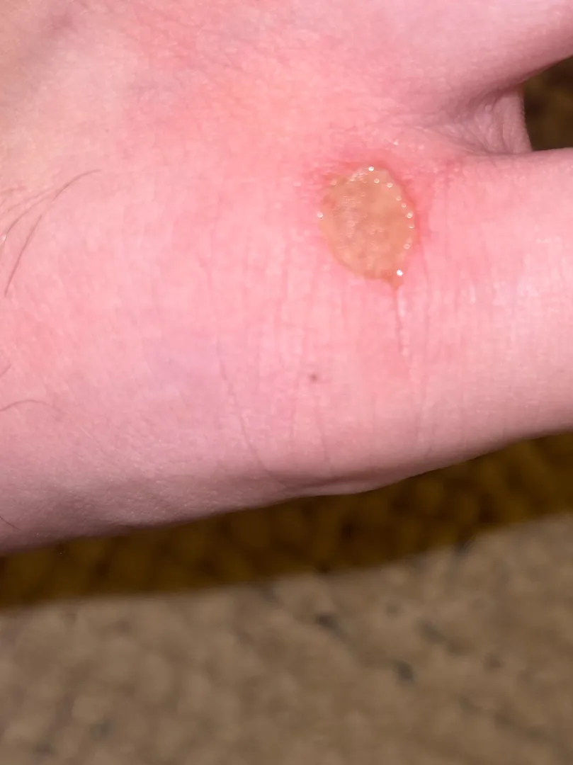 Infected? posted by EnthusiasmUpstairs23