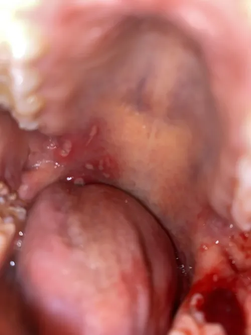 Injuries after a wisdom teeth removal surgery by AdorableSupport7143