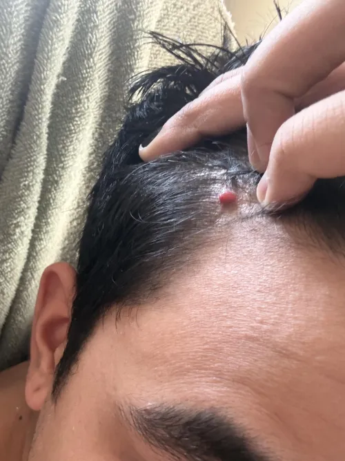 Is this a cherry angioma, it doesn’t hurt at least I press it really hard by josecqe