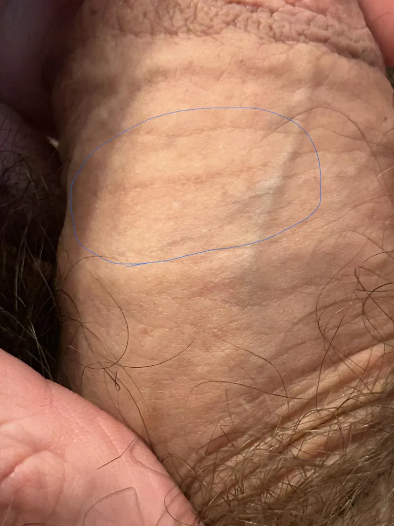 Is this a stretch mark or just a normal skin wrinkle? posted by XenoNSFW3