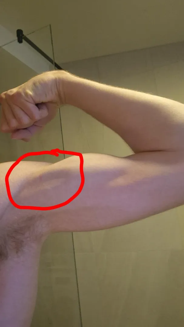 Is this dent on the bicep normal when i flex the muscle or should i be concerned, it is only on my right arm. Might matter but i have been practicing volleyball intensely for a few years and am 18M posted by throwaaway26q749